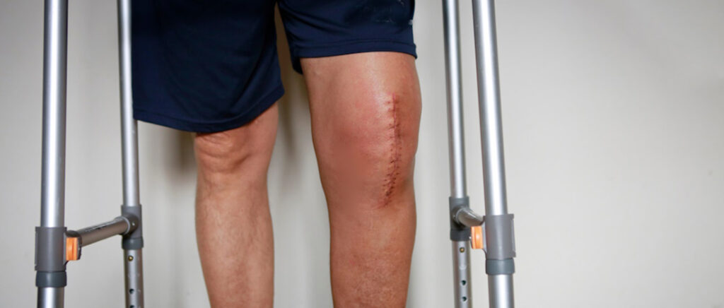 The VA Rating For Surgery Scars